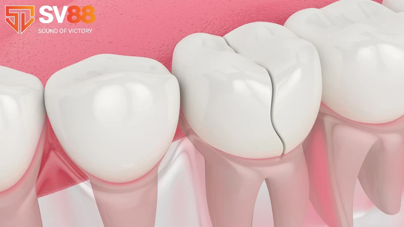 Giải mã giấc mơ bị sâu răng - Điềm báo và số may mắn 4 Nằm mơ thấy răng sâu bị vỡ thành nhiều mảnh